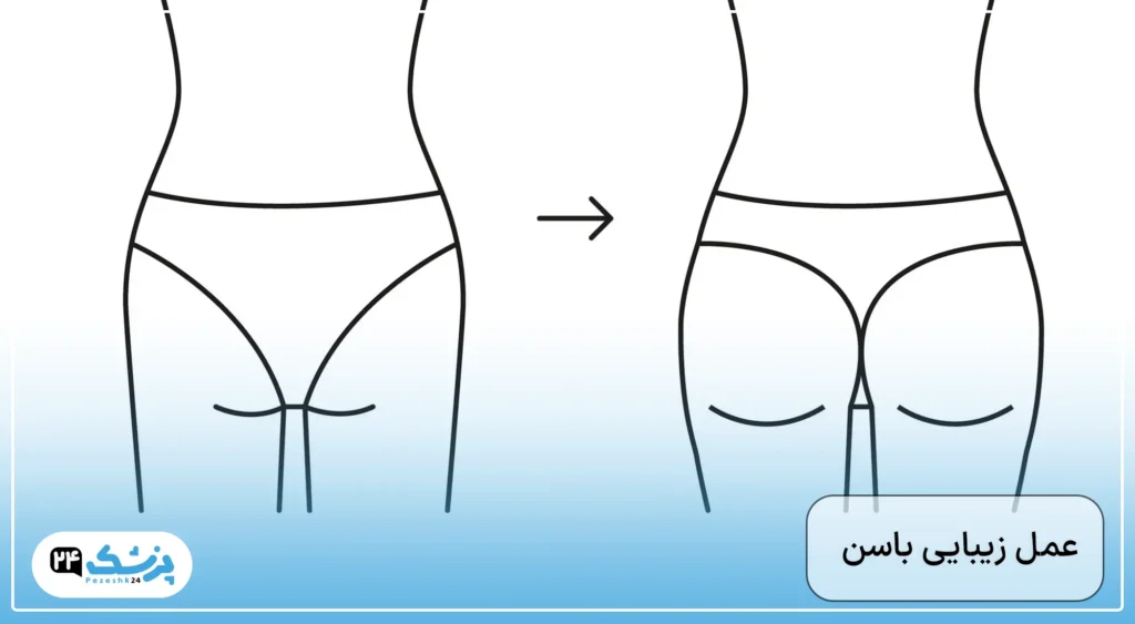 جراحی باسن