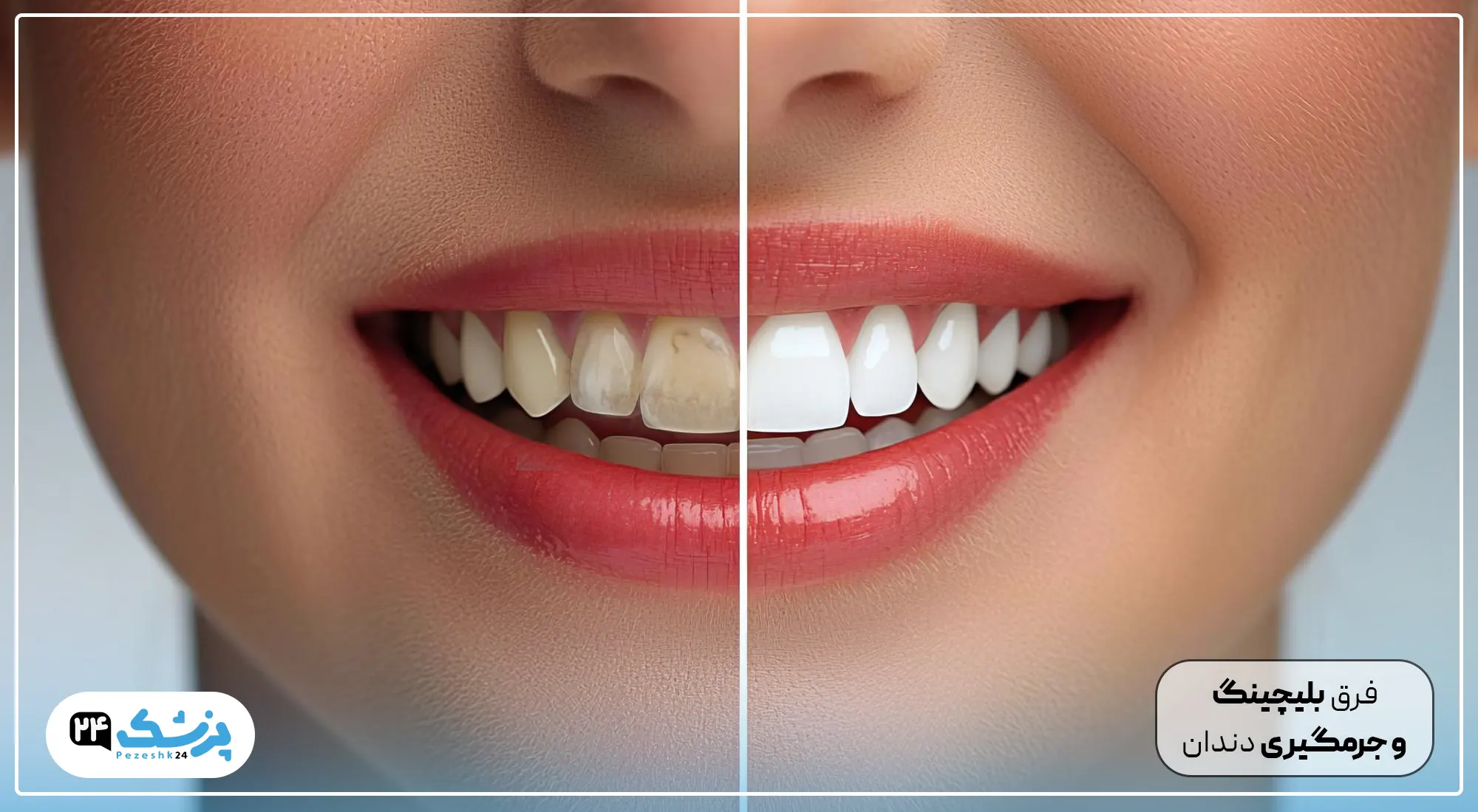 تفاوت بلیچینگ و جرمگیری