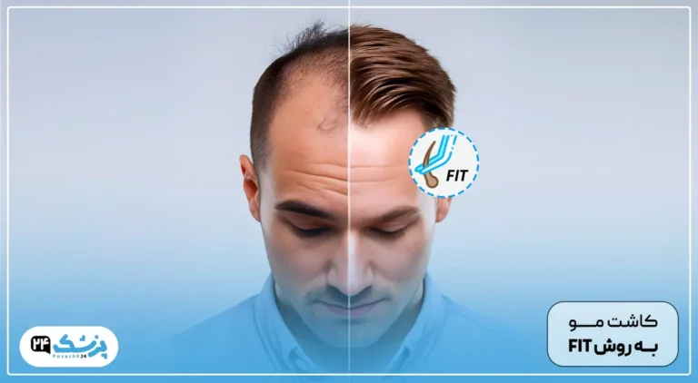 کاشت مو به روش fit