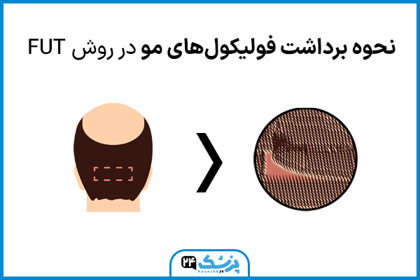 نحوه برداشت فولیکول برای FUT