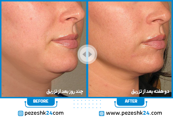 عکس قبل و بعد مزوتراپی غبغب