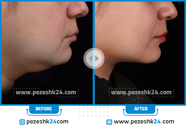 عکس قبل و بعد مزوتراپی غبغب 1