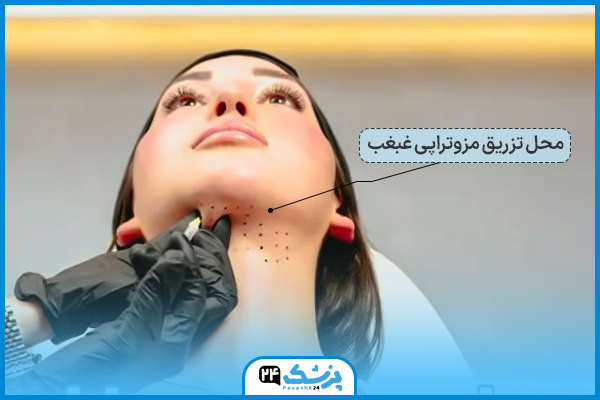 محل تزریق مزوتراپی غبغب