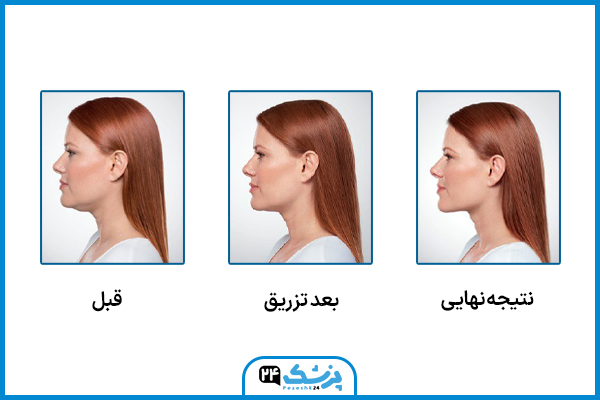 نتیجه تدریجی مزو غبغب