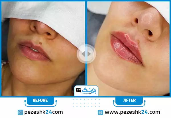نمونه کار قبل و بعد تزریق ژل لب طبیعی با حجم دهی ملایم توسط دکتر محمد بهبودی فرد
