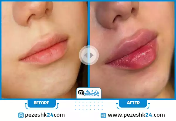 نمونه قبل و بعد تزریق ژل لب مدل چری (Cherry Lip) توسط دکتر محمد بهبودی فرد در مشهد