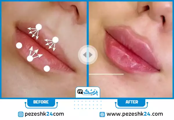 نمونه قبل و بعد تزریق ژل لب مدل کلاسیک (Classic Lip) توسط دکتر محمد بهبودی فرد در مشهد