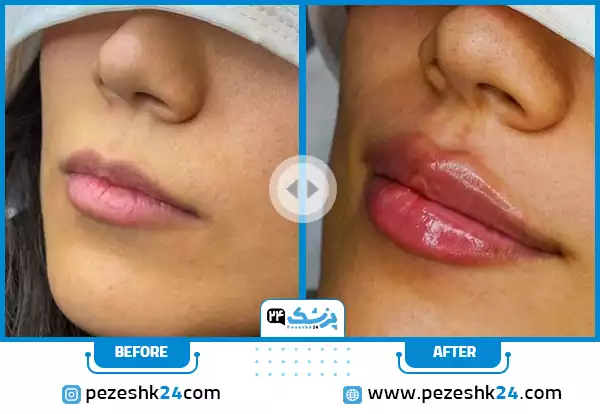 نمونه کار قبل و بعد تزریق ژل لب روسی با حجم بیشتری در مرکز و لیفت بیشتری در لب بالا دکتر بهبودی فرد