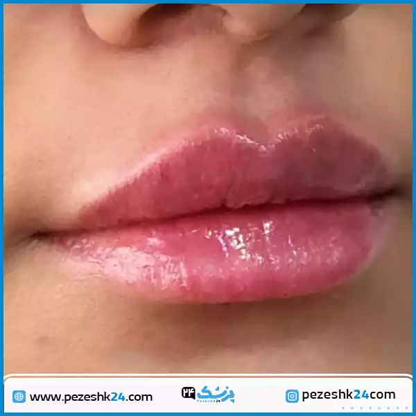 عکس تزریق فیلر لب با تمرکز بر فرمدهی کمان لب و افزایش حجم متعادل کلینیک رز