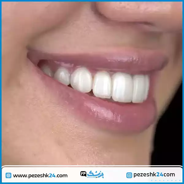 نمونه کار لمینت دندان دکتر مهزیار سیحون در تهران
