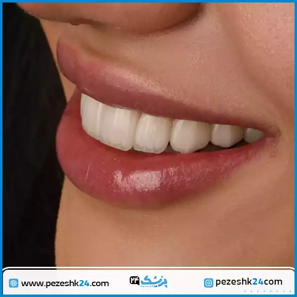 نمونه کار لمینت دندان دکتر مهزیار سیحون در تهران