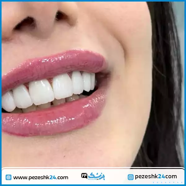 نمونه کار لمینت دندان دکتر مهزیار سیحون در تهران