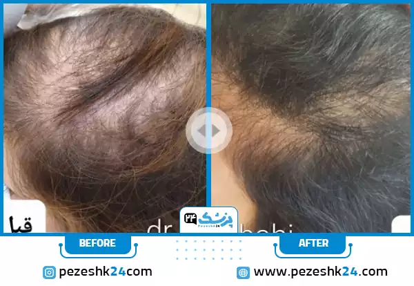 عکس قبل و بعد از پی آر پی مو دکتر علمشاهی