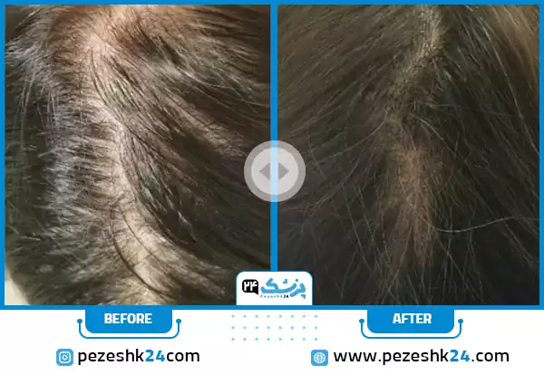 عکس قبل و بعد از تزریق پی آر پی مو دکتر علمشاهی