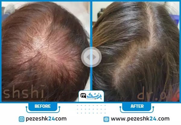 عکس تزریق پی ار پی مو دکتر علمشاهی