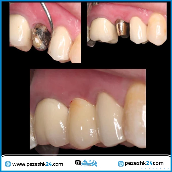 قبل و بعد از ایمپلنت دندان دکتر میرشکار