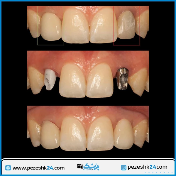 قبل و بعد از ایمپلنت دندان دکتر میرشکار تهران