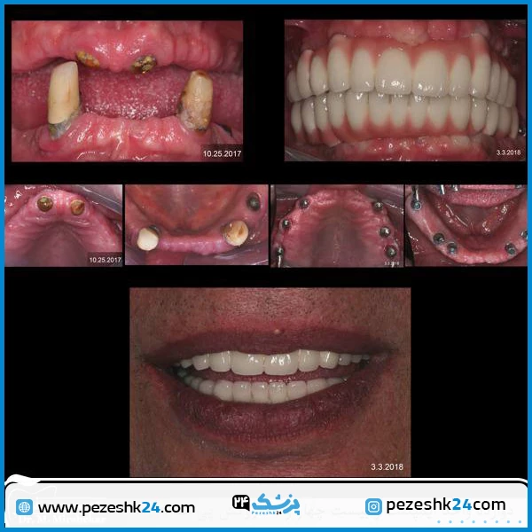 قبل و بعد از ایمپلنت دندان دکتر میرشکار