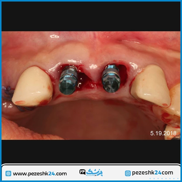 قبل و بعد از ایمپلنت دندان دکتر میرشکار تهران