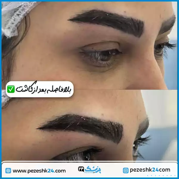 قبل و بعد کاشت ابرو کلینیک شریعتی اصفهان