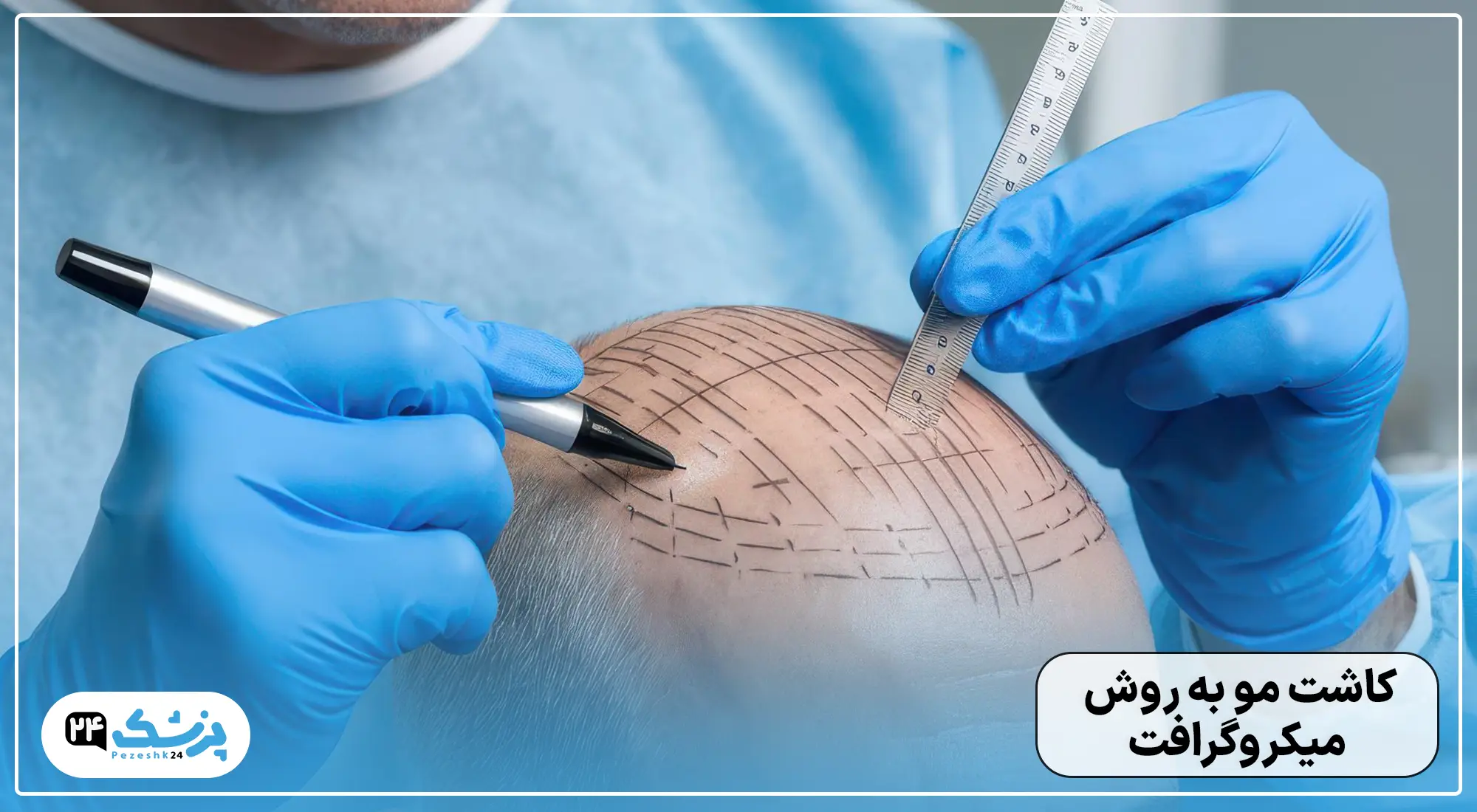 کاشت مو به روش میکروگرافت