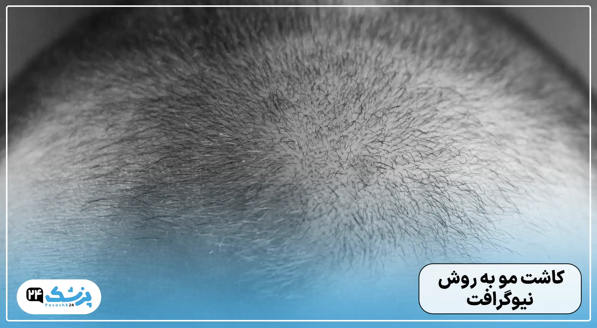 کاشت مو به روش نیو گرافت