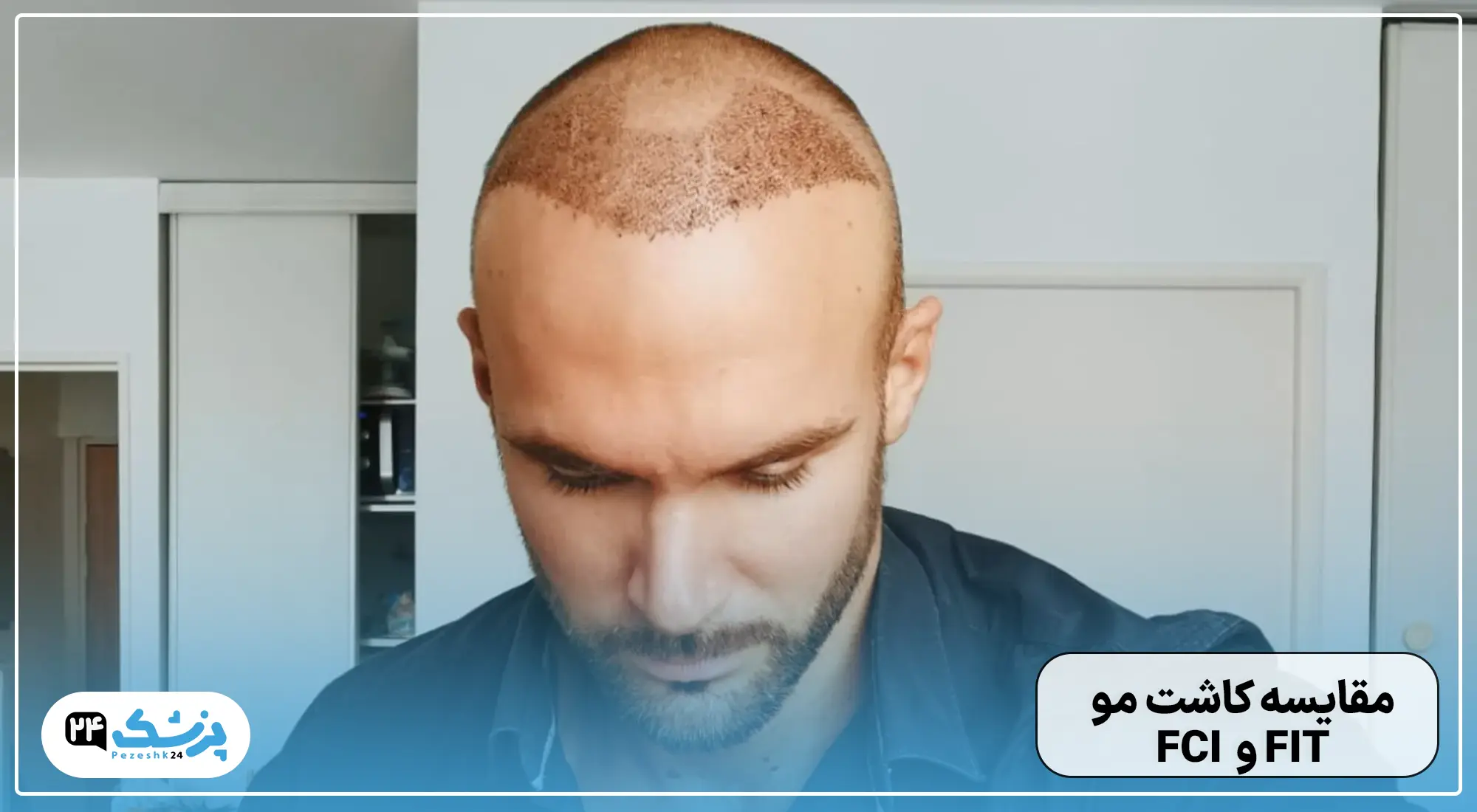 مقایسه کاشت مو FIT و FCI