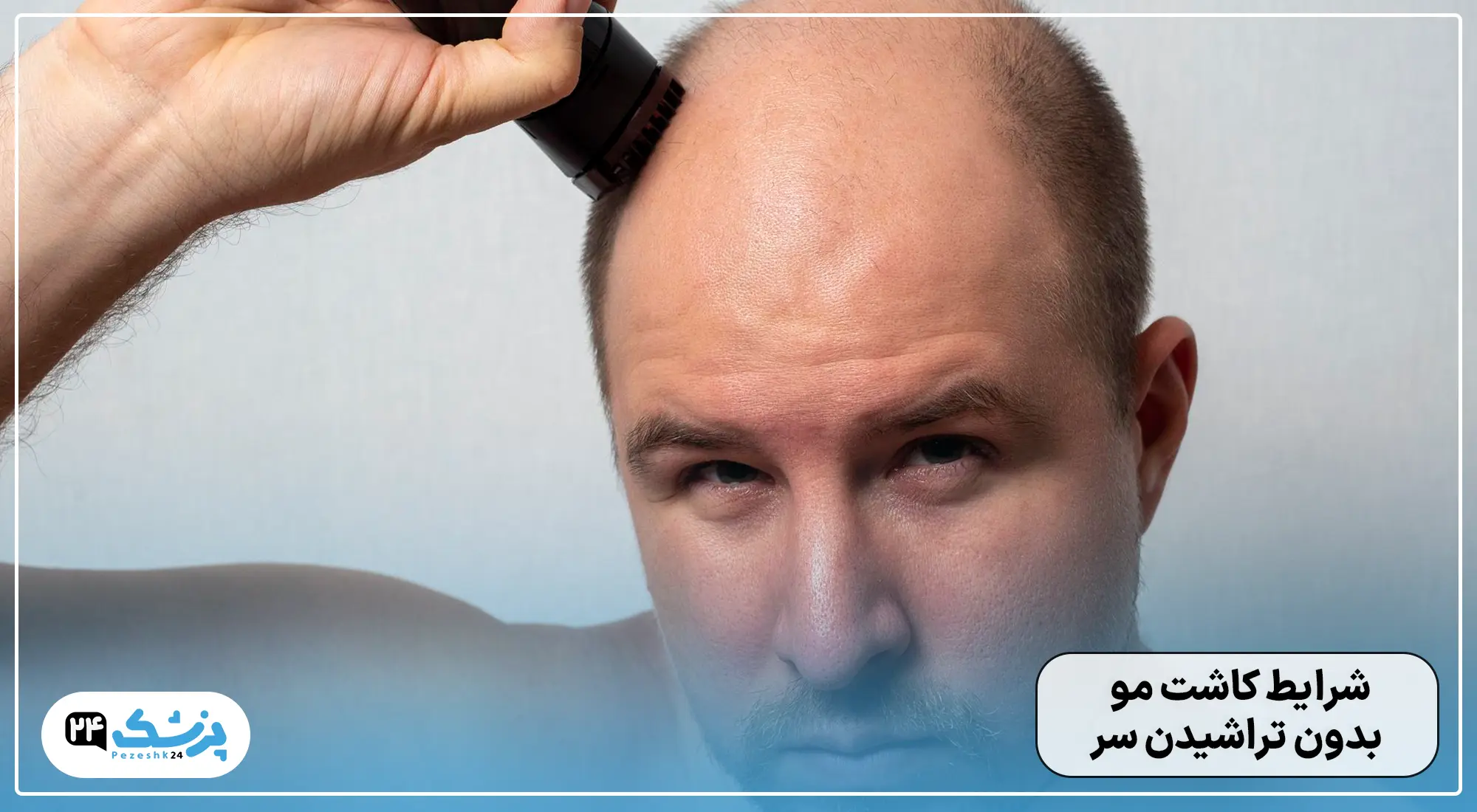 کاشت مو بدون تراشیدن سر