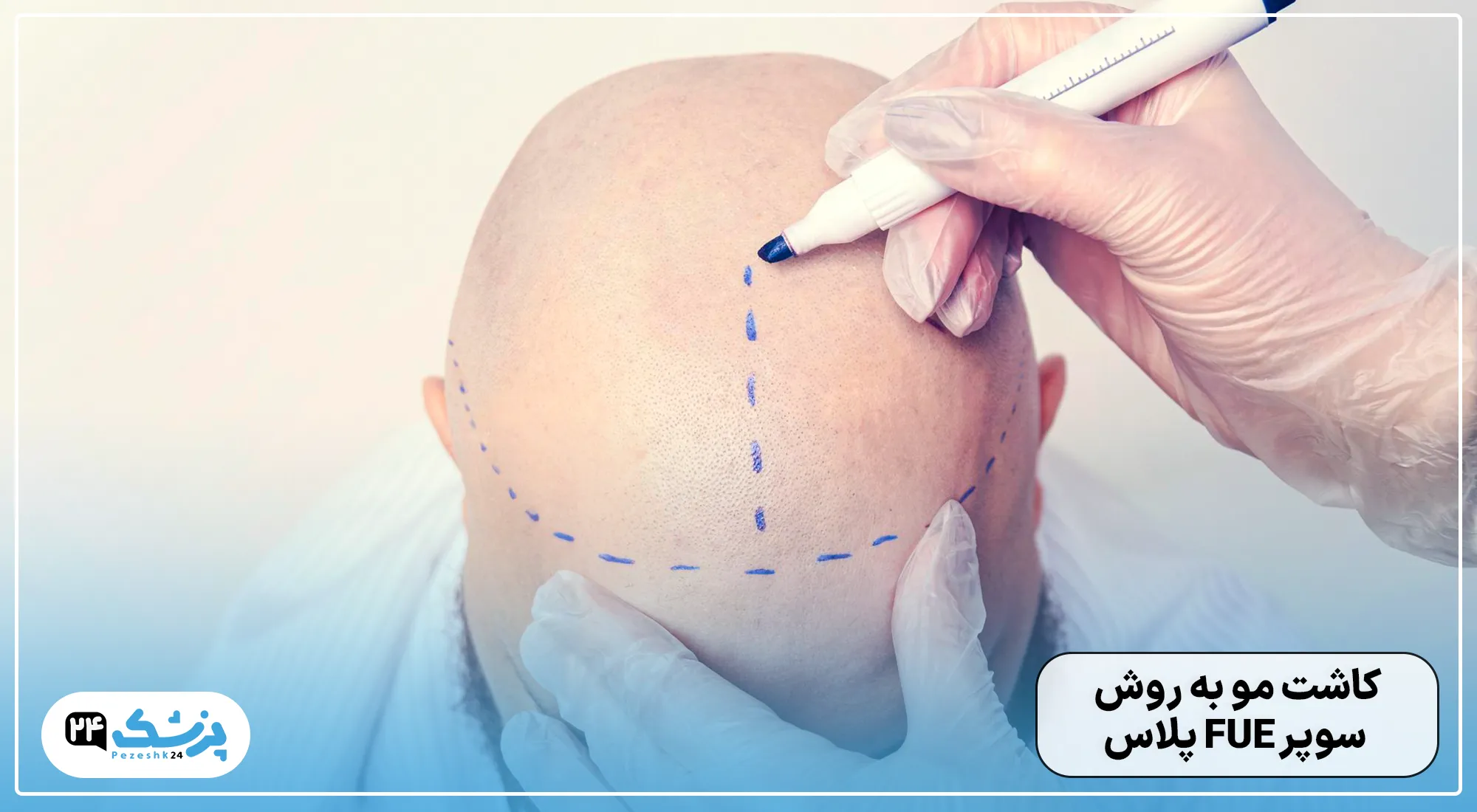 کاشت مو به روش سوپر FUE پلاس