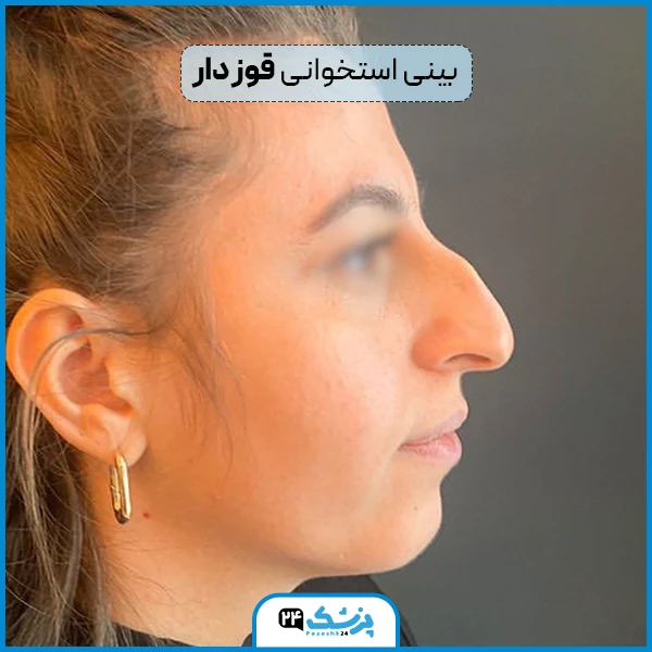 بینی استخوانی همراه با قوز