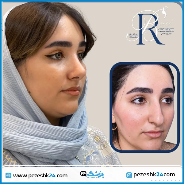 نمونه عمل بینی دکتر رسولیان