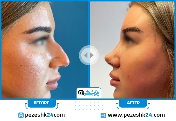 جراحی قوز بینی استخوانی