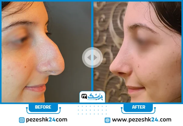 روشهای جراحی بینی استخوانی قوزدار