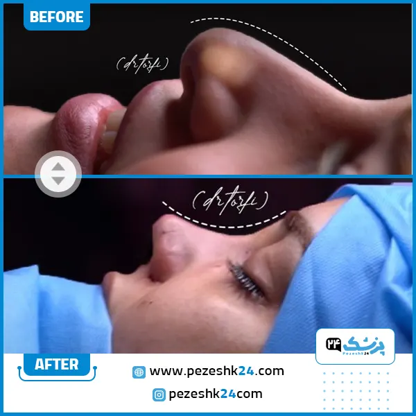 نمونه کار قبل و بعد عمل بینی گوشتی افتاده دکتر طرفی در اهواز