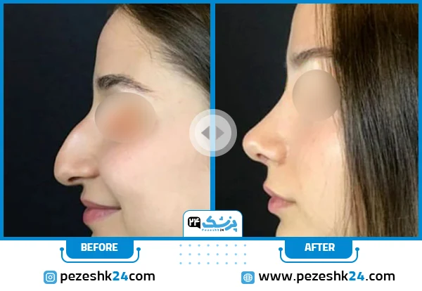 نمونه جراحی بینی قوزدار استخوانی دخترانه