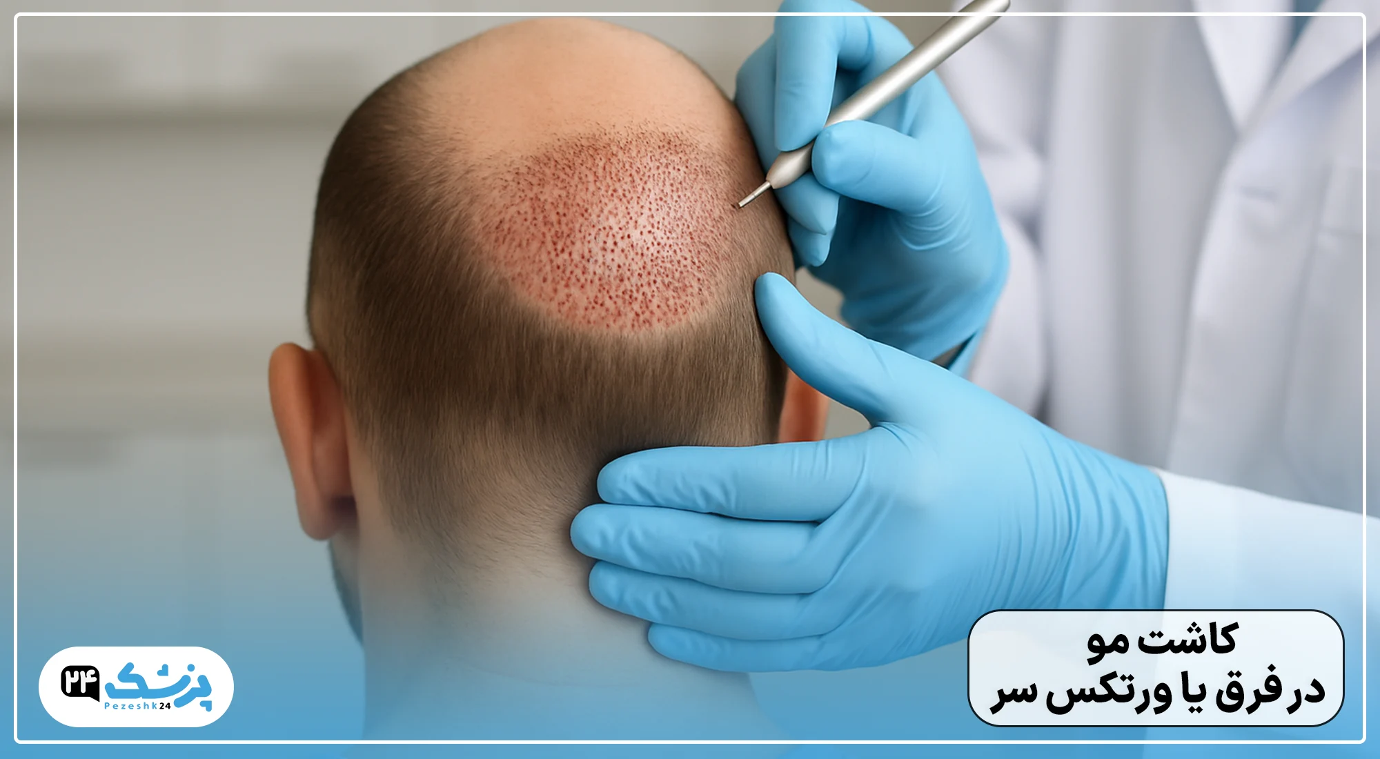 کاشت مو در فرق یا ورتکس سر