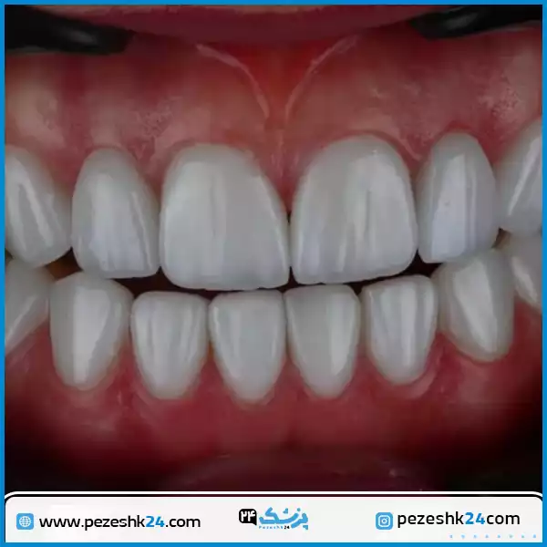 نمونه کار لمینت زیبایی دندان در تهران
