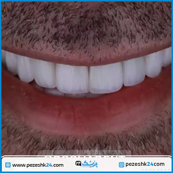 نمونه کار لمینت دندان در کلینیک دندانپزشکی روشا تهران