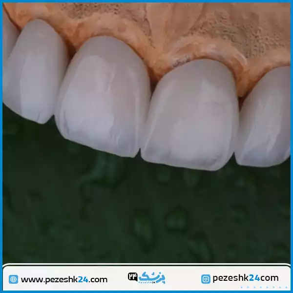 لمینت زیبایی دندان در کلینیک روشا تهران