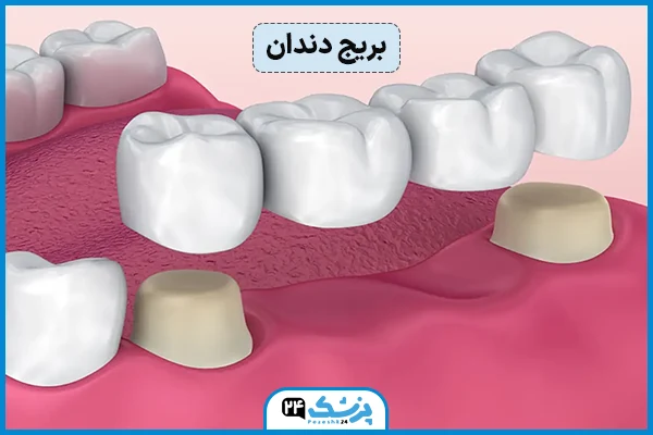 پل دندان