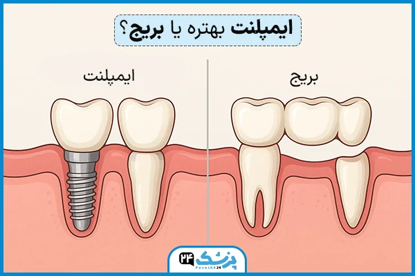 پل دندان بهتر است یا ایمپلنت