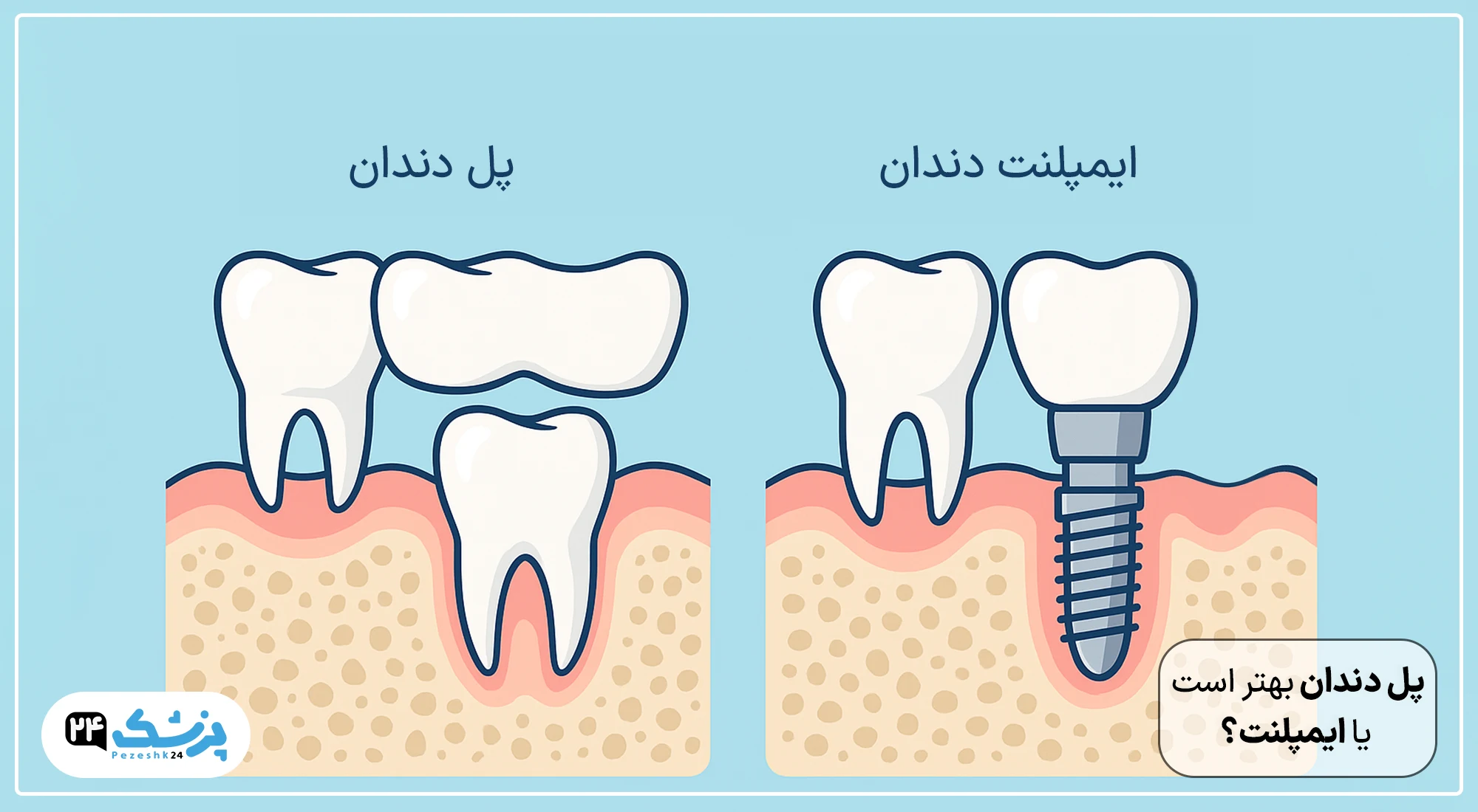 دندان چسبی بهتر است یا ایمپلنت