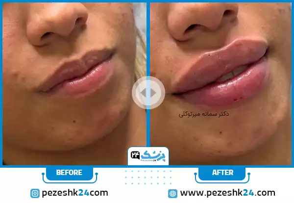 نمونه کار قبل و بعد تزریق ژل لب اردکی دکتر سمانه میرتوکلی در مشهد