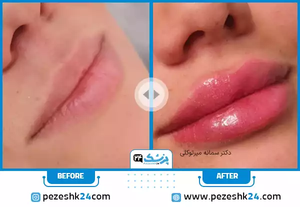 نمونه کار قبل و بعد تزریق ژل لب عروسکی طبیعی دکتر سمانه میرتوکلی در مشهد
