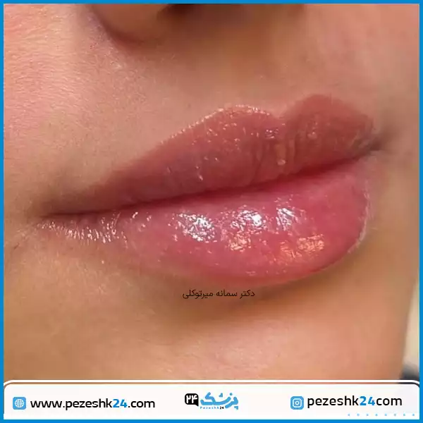 نمونه کار تزریق ژل لب طبیعی دکتر سمانه میرتوکلی در مشهد