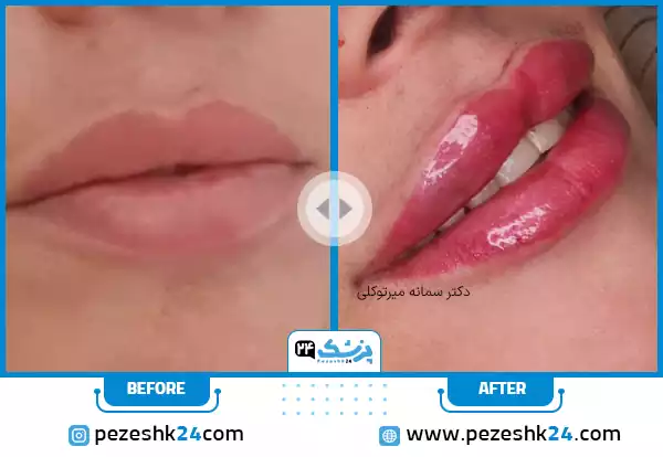نمونه کار قبل و بعد تزریق ژل لب روسی دکتر سمانه میرتوکلی در مشهد