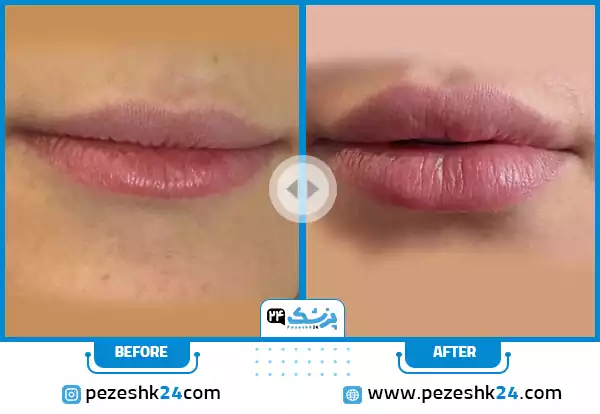 نمونه کار قبل و بعد تزریق ژل لب طبیعی آمیتیس بهترین کلینیک تزریق ژل لب در شیراز