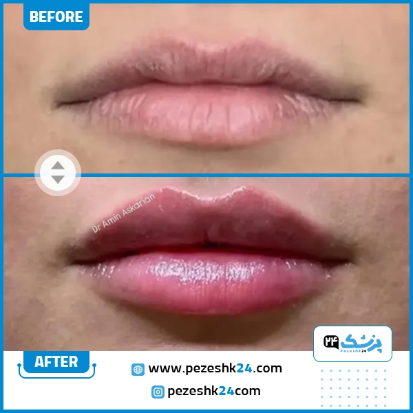 قبل و بعد ژل لب دکتر امین عسکریان