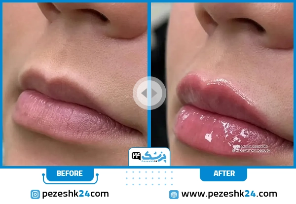 قبل و بعد ژل لب دکتر امین عسکریان شیراز