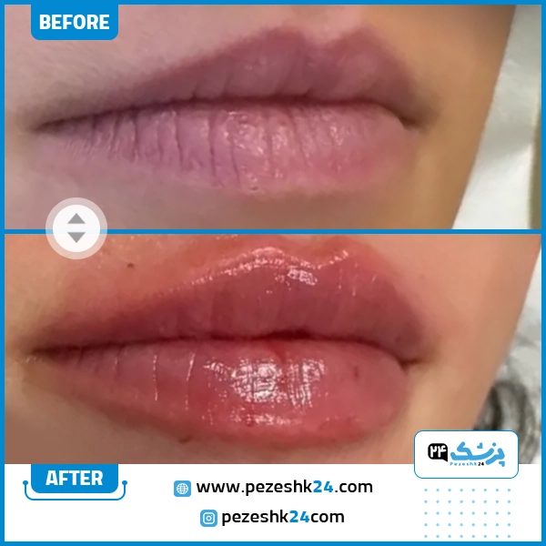 قبل و بعد تزریق ژل لب دکتر امین عسکریان شیراز